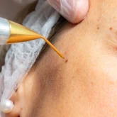 precision-versatility-plasma-pen-balance-medical-day-spa-columbia-sc